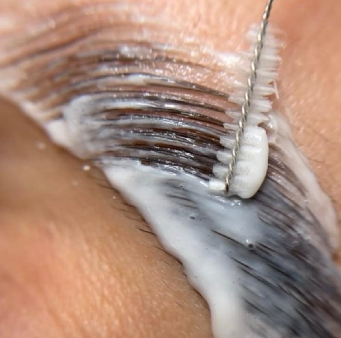 Browlift